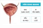 Viêm bàng quang: Nguyên nhân dấu hiệu và cách chữa an toàn, hiệu quả