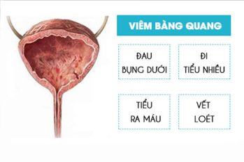 Viêm bàng quang: Nguyên nhân dấu hiệu và cách chữa an toàn, hiệu quả