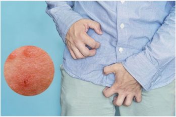Nguyên nhân ngứa bao quy đầu ở nam giới và Cách khắc phục hiệu quả