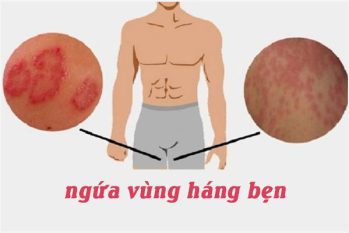 Ngứa vùng háng ở nam giới: Nguyên nhân và Cách khắc phục hiệu quả