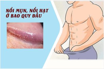 Bao quy đầu nổi hột, nổi mụn bất thường có sao không? Địa chỉ khám nam khoa uy tín